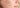 That Tell Hormonal Acne to F ck Off! Why Teen Dream is the Answer