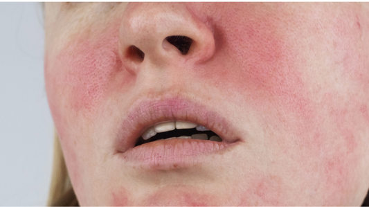 Skin Hangovers 101: When Your Skin Experiment Goes Sideways