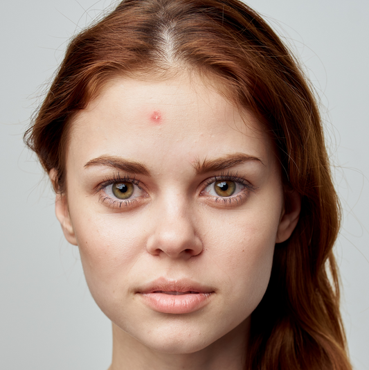 Preventing and Healing Pimples