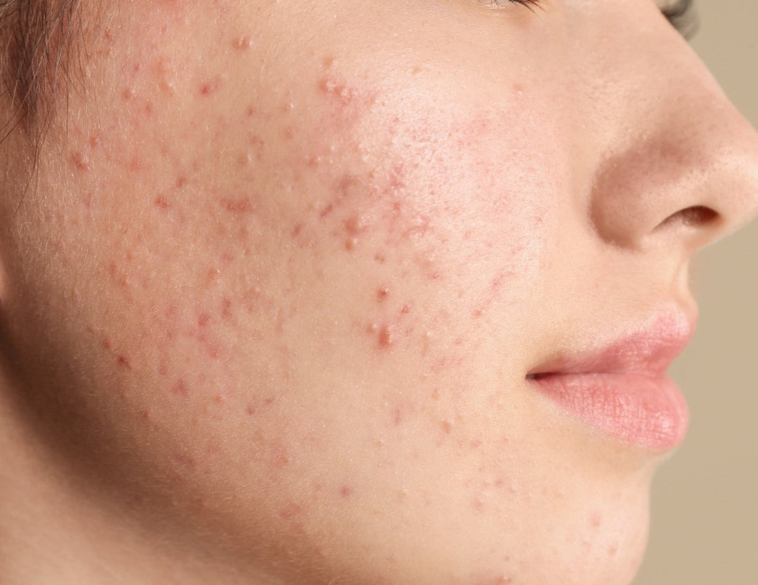 That Tell Hormonal Acne to F ck Off! &nbsp;Why Teen Dream is the Answer