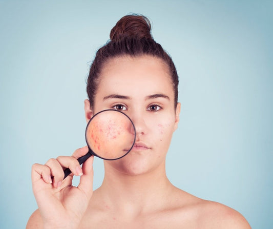 Hormones + Acne