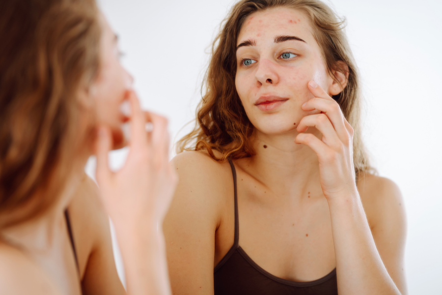 Why Your Skin Breaks Out Every Summer (And Why More Products Make It Worse)