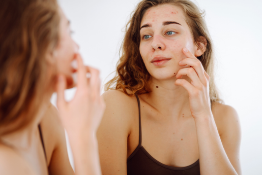 Why Your Skin Breaks Out Every Summer (And Why More Products Make It Worse)